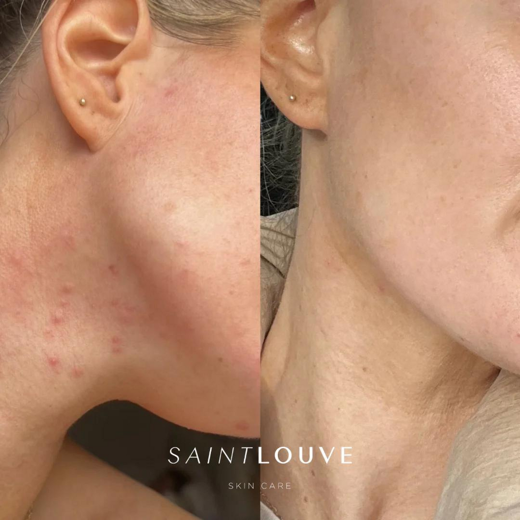 Get Supermodel Skin in 6 Weeks: A Clear and Radiant Transformation with Saint Louve Skincare