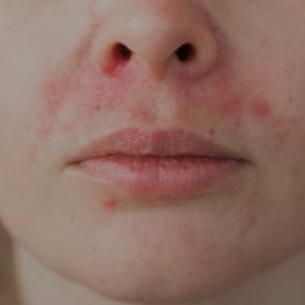What to do if you have Peri-Oral Dermatitis